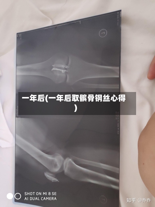 一年后(一年后取髌骨钢丝心得)-第1张图片