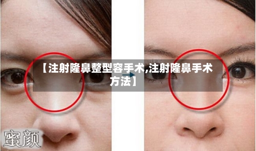 【注射隆鼻整型容手术,注射隆鼻手术方法】-第1张图片