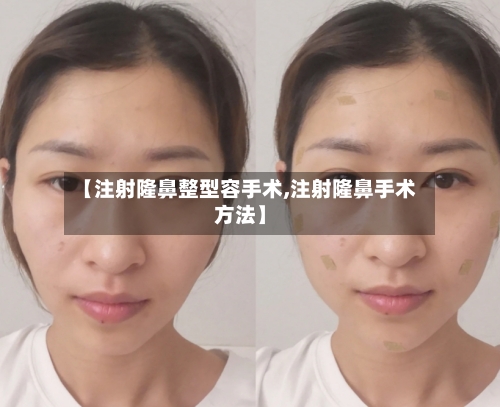 【注射隆鼻整型容手术,注射隆鼻手术方法】-第3张图片